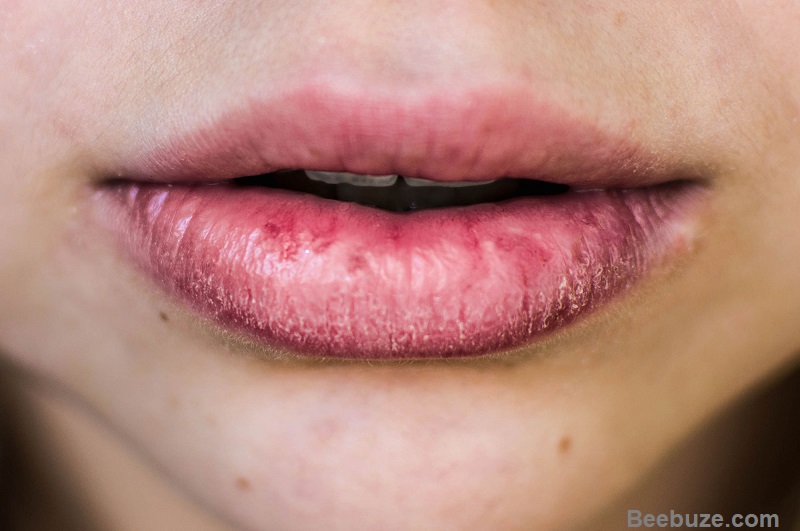 Home Remedies For Cracked Lips