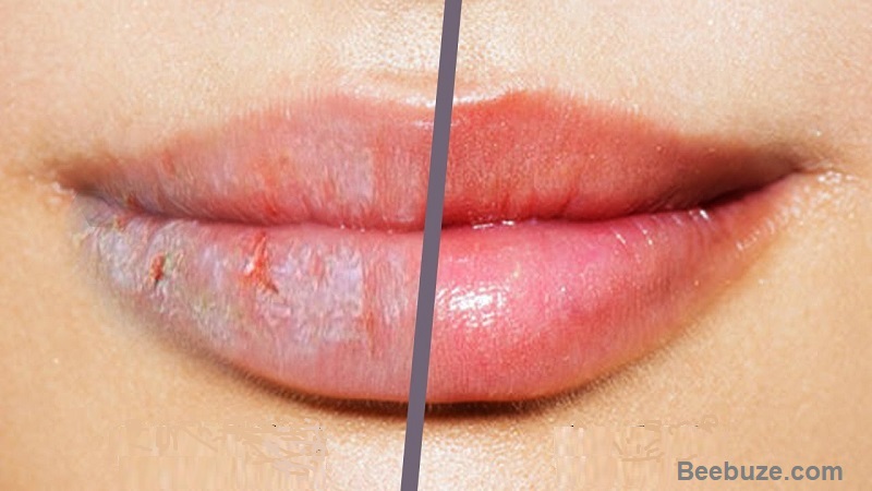 Home Remedies For Cracked Lips