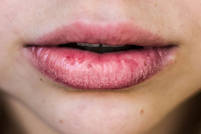 Home Remedies For Cracked Lips