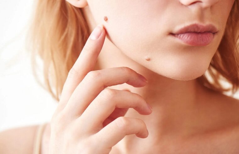 Banish Moles for Good: The Ultimate Guide to Mole Removal