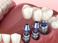 latest breakthroughs that are shaping the future of dental implantology.