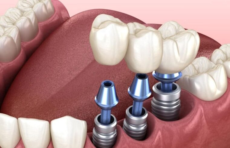 Exploring the Latest Advances in Dental Implants