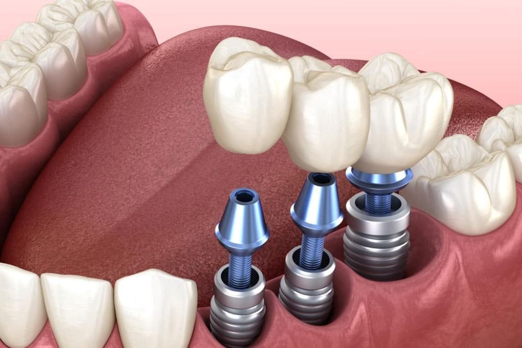 Exploring the Latest Advances in Dental Implants