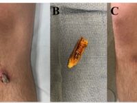 Is it possible for surgical screws to come out