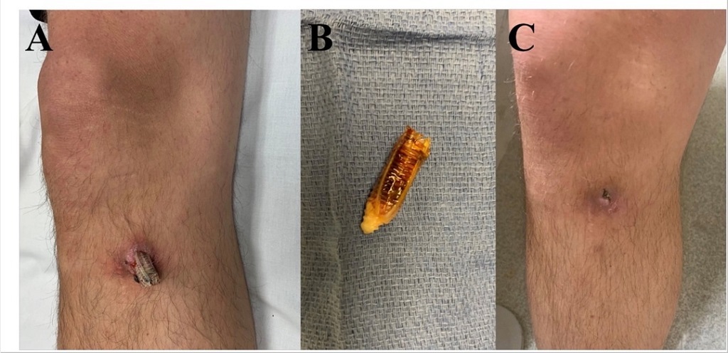 What Happens When a Surgical Screw Comes Loose?