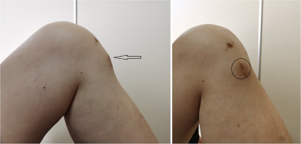 Why Do Surgical Screws Come Loose